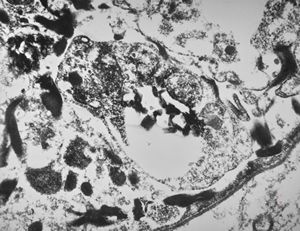 M, | cerebral cortex - malaric pigment